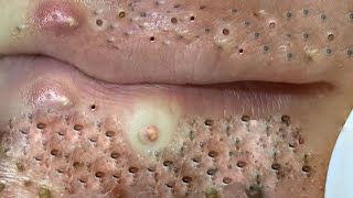 Big Cystic Acne Blackheads Extraction Blackheads amp Milia Whiteheads Removal Pimple Popping  1973 [upl. by Sherrer]