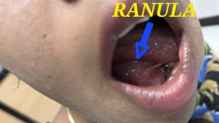 Ranula  Sublingual gland Retention cyst  Salivary gland  marsupialization  Surgical treatment [upl. by Hillel]