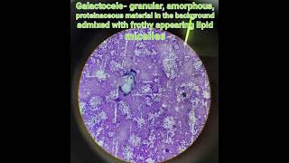 Cytologygalactocelebenign breast disease pathologymedical [upl. by Putnam555]