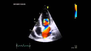 Dialysis echocardiogram 22 [upl. by Amat]