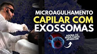 Microagulhamento CAPILAR com EXOSSOMAS  Aula prática [upl. by Eeralav]