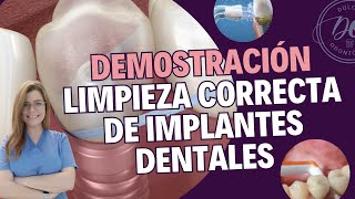 Como LIMPIAR los IMPLANTES DENTALES para mantenerlos SANOS  🦷💦 [upl. by Yeknarf498]