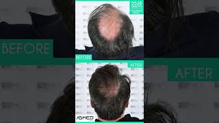 Manual FUE Hair Transplant Before amp After 5538 Grafts 20Month Result  ASMED  Dr Koray Erdogan [upl. by Lithea]