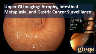 Upper GI Imaging Atrophy Intestinal Metaplasia and Gastric Cancer Surveillance [upl. by Nesmat]