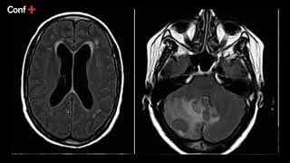 Cas dimagerie lésion focale hémisphérique cérébelleuse droite avec oedème périlésionnel [upl. by Elem379]