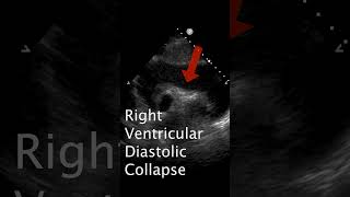 Signs of Pericardial Tamponade POCUS ultrasound emergencymedicinecardiology criticalcare [upl. by Court]