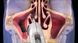 balloon dilatation of the sinuses  treatment for sinusitis [upl. by Kenti]