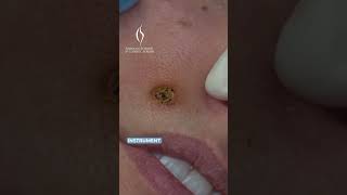 Scarless Mole Removal Dr Niamtus Breakthrough moleremoval medicaleducation cosmeticsurgery [upl. by Clancy]