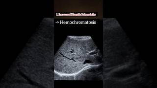 Hemochromatosis leading to Coarse Liver ❤️💯 HealthAwareness LiverHealth medical ultrasound [upl. by Baalbeer]