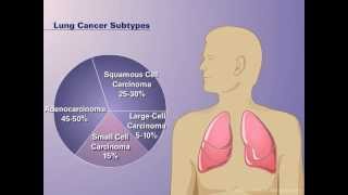 The Pathophysiology of Nonsmall Cell Lung Cancer [upl. by Joice]