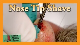 Nose Shave Biopsy Results in a Brown Noser  Auburn Medical Group [upl. by Elleinod]