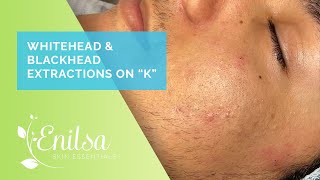 Enilsa is back Whitehead amp Blackhead Extractions on quotKquot  Part 1 [upl. by Nyliac]