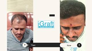 Miraculous Hair Regrowth with iGraft GFC  BioCell Treatment  Mr Narayans Transformation Story [upl. by Alleuqcaj]