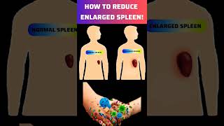 How To Treat Enlarged Spleen  How To Reduced Enlarged Spleen spleen [upl. by Gaulin]