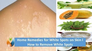 Home Remedies for White Spots on Skin l How to Remove White Spots [upl. by Gnuh]