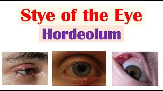 Eye Stye Hordeolum  Causes Symptoms Diagnosis amp At Home Treatments [upl. by Anivol]