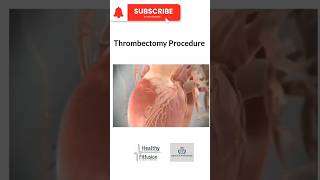 Thrombectomy Procedure  HealthyFitFusion195 shorts viralshorts medicaleducation facts live [upl. by Eat642]