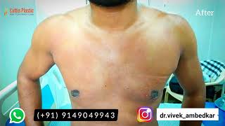 Chest Fat Transformation  Menboobs Ayodhya Ambedkar Nagar Khushi Nagar Kanpur Sant Kabir Nagar [upl. by Marlon]