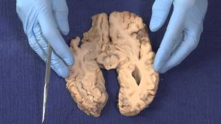 Basal Ganglia Neuroanatomy Video Lab  Brain Dissections [upl. by Hada]