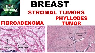 Diseases of Breast Part 3 Fibroadenoma amp Phyllodes tumor [upl. by Sydney]