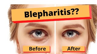 Blepharitis How to treat Blepharitis Best Home Treatment [upl. by Aiveneg475]