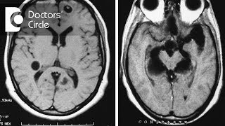 What do granuloma with Neurocysticercosis amp Tuberculoma in MRI brain signify  Dr Vykunta Raju K N [upl. by Nayar]