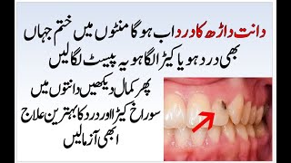 Teeth Pain Treatment At Home  Teeth Cavity Removal  Dant Dard Ka Ilaj [upl. by Yoko]