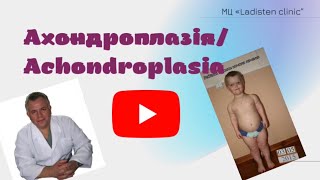 Ахондроплазия Результат леченияAchondroplasia Treatment result [upl. by Bunnie750]