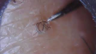 Long ingrown hair removal 23 [upl. by Chon909]