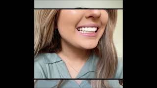 Before amp After Instant Smile Teeth Veneers 2023 [upl. by Irmo]