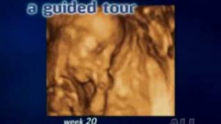 Echographie vidéo 3D du foetus [upl. by Eimarej]