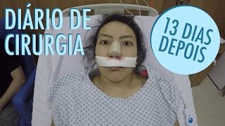 TUDO SOBRE MINHA RINOPLASTIA  PRÉ E PÓS OPERATÓRIO  ANTES E DEPOIS [upl. by Shawnee]