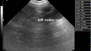 ovary cystavi [upl. by Redan]