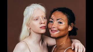 Albinism Symptoms and Causes  Diagnosis  Treatment  Prevention [upl. by Petulah]