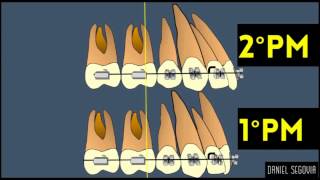 Extracción de segundos premolares en ortodoncia [upl. by Sterling]