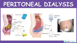 Peritoneal Dialysis Introduction Physiology Technique Modes and Complications [upl. by Dorrehs300]