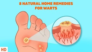 8 Surprising Home Remedies for Warts  Get Rid of Them Naturally [upl. by Sophy]