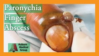 Paronychia Fingernail Abscess Infection Treatment  Auburn Medical Group [upl. by Llamaj]