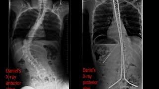 Successful Posterior Spinal Fusion ♬💖🎶 BeforeAfter4days hospitalization documentary [upl. by Lewin]