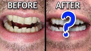 Do teeth whitening kits actually work [upl. by Rumpf889]