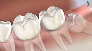 Wisdom Teeth Removal in Danbury CT  Greater Connecticut Oral amp Dental Implant Surgery [upl. by Caasi]