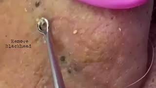 Acne Removal Remove blackhead on his lips noses removeblackhead [upl. by Tobias923]