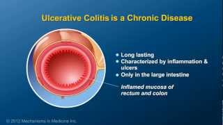 What is Ulcerative Colitis [upl. by Aitnis692]