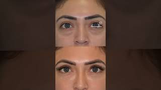 Before amp After Under Eye Filler [upl. by Weikert]