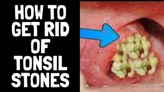 Deep Tonsil Stone Removal  Tonsil Stones [upl. by Winter]