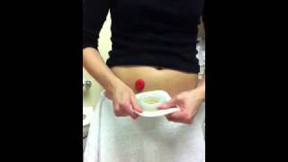 Ostomy pouch change using ConvaTec moldable [upl. by Aleedis903]