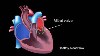 Physiology of rheumatic heart disease [upl. by Yllehs]