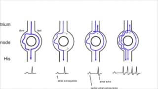 AVNRT AV nodal reentrant tachycardia [upl. by Seif]