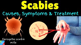 Scabies Causes Symptoms Diagnosis Treatment amp Prevention [upl. by Casteel]