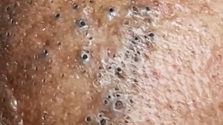 Blackheads amp Whiteheads Satisfying Removal 0050 [upl. by Iggy961]